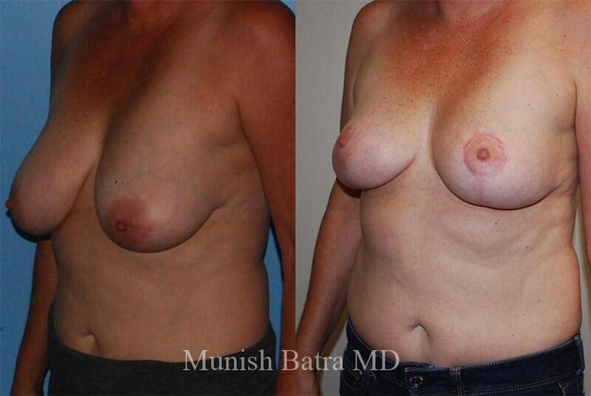 Breast Lift Before & After Gallery - Patient 258144 - Image 2