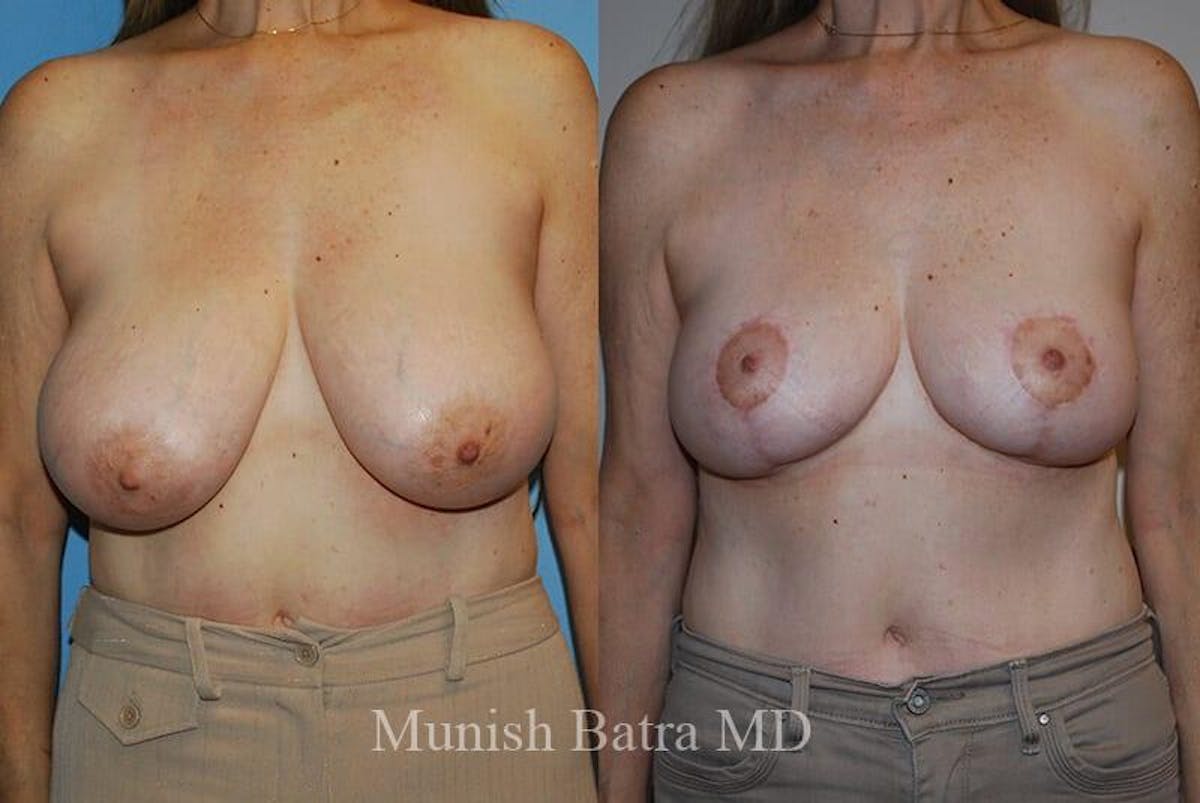 Breast Lift Before & After Gallery - Patient 181203 - Image 1