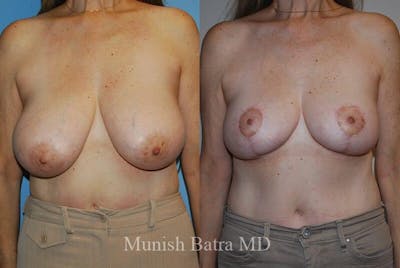 Breast Lift Before & After Gallery - Patient 181203 - Image 1