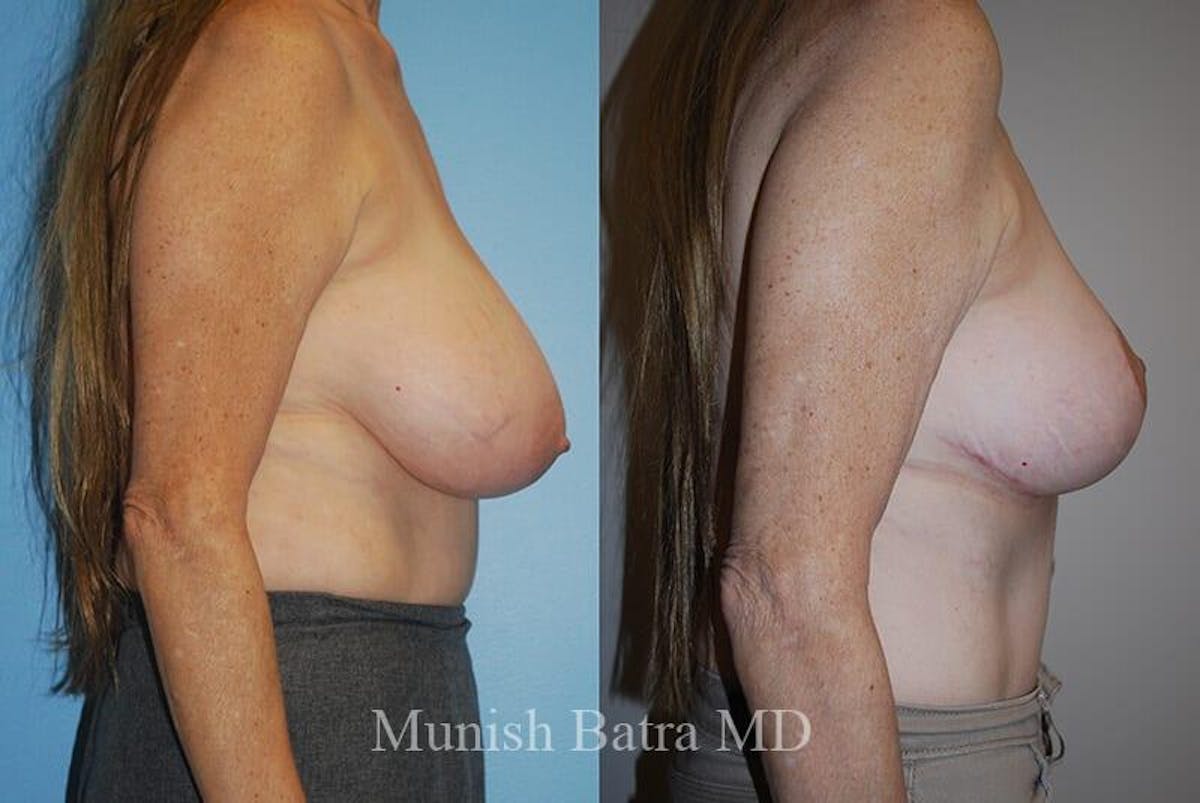 Breast Lift Before & After Gallery - Patient 181203 - Image 2