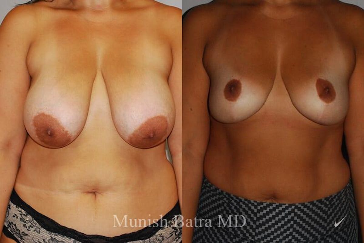 Breast Lift Before & After Gallery - Patient 130903 - Image 1