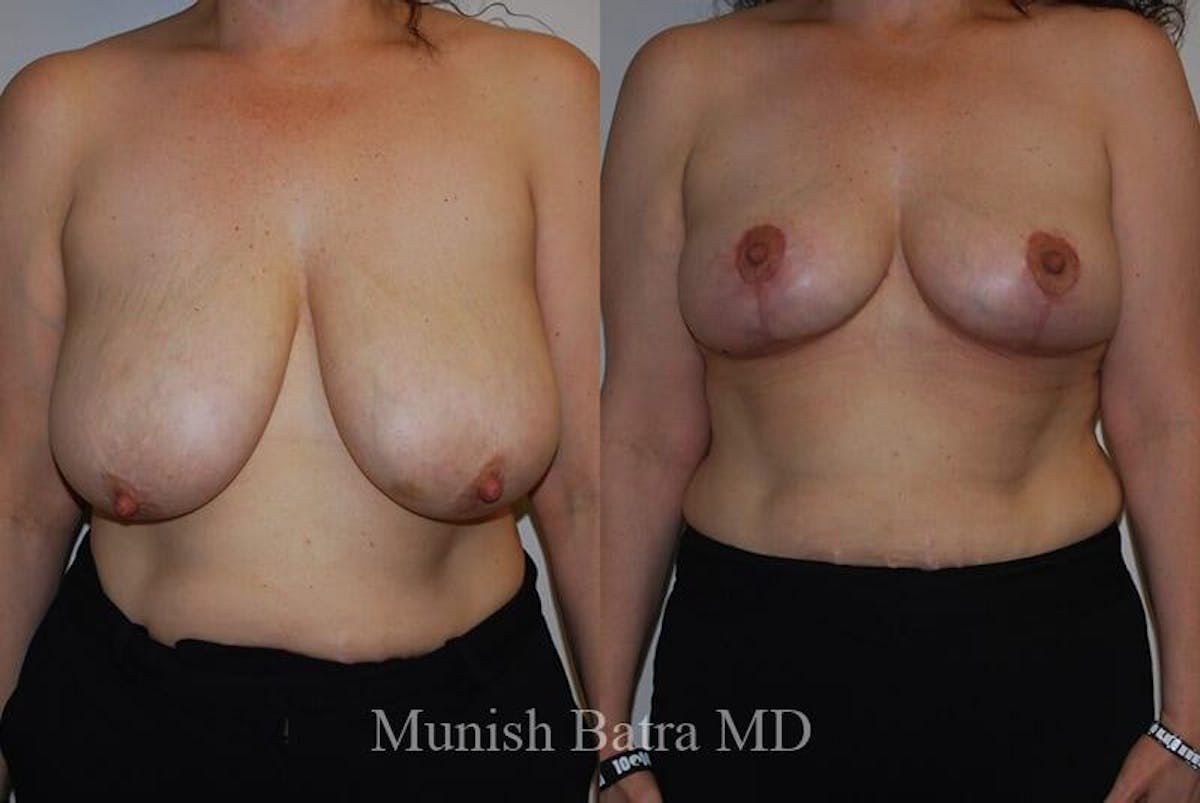 Breast Lift Before & After Gallery - Patient 857252 - Image 1