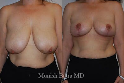 Breast Lift Before & After Gallery - Patient 857252 - Image 1