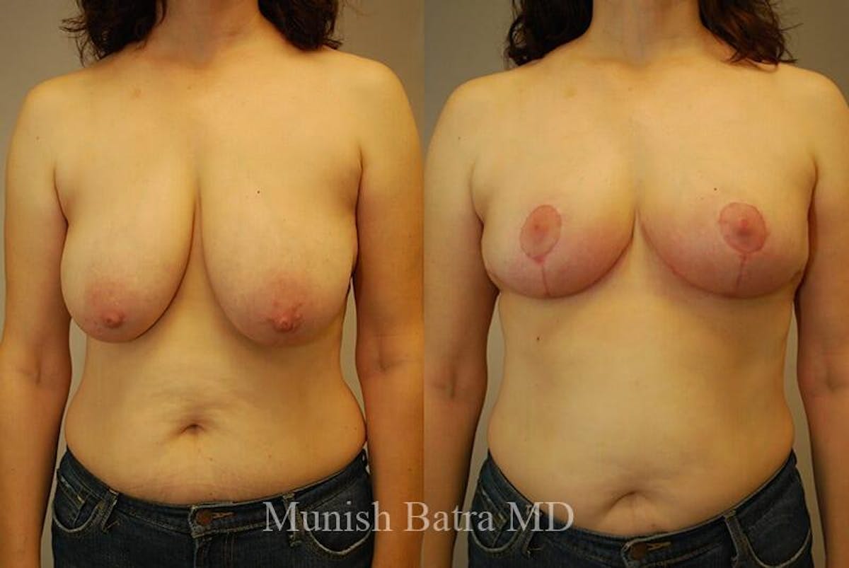 Breast Lift Before & After Gallery - Patient 934655 - Image 1