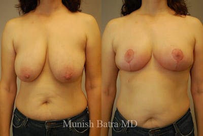 Breast Lift Before & After Gallery - Patient 934655 - Image 1