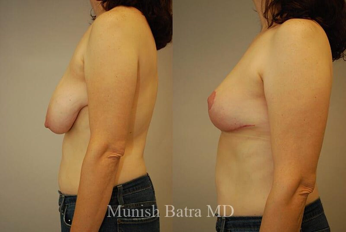 Breast Lift Before & After Gallery - Patient 934655 - Image 2