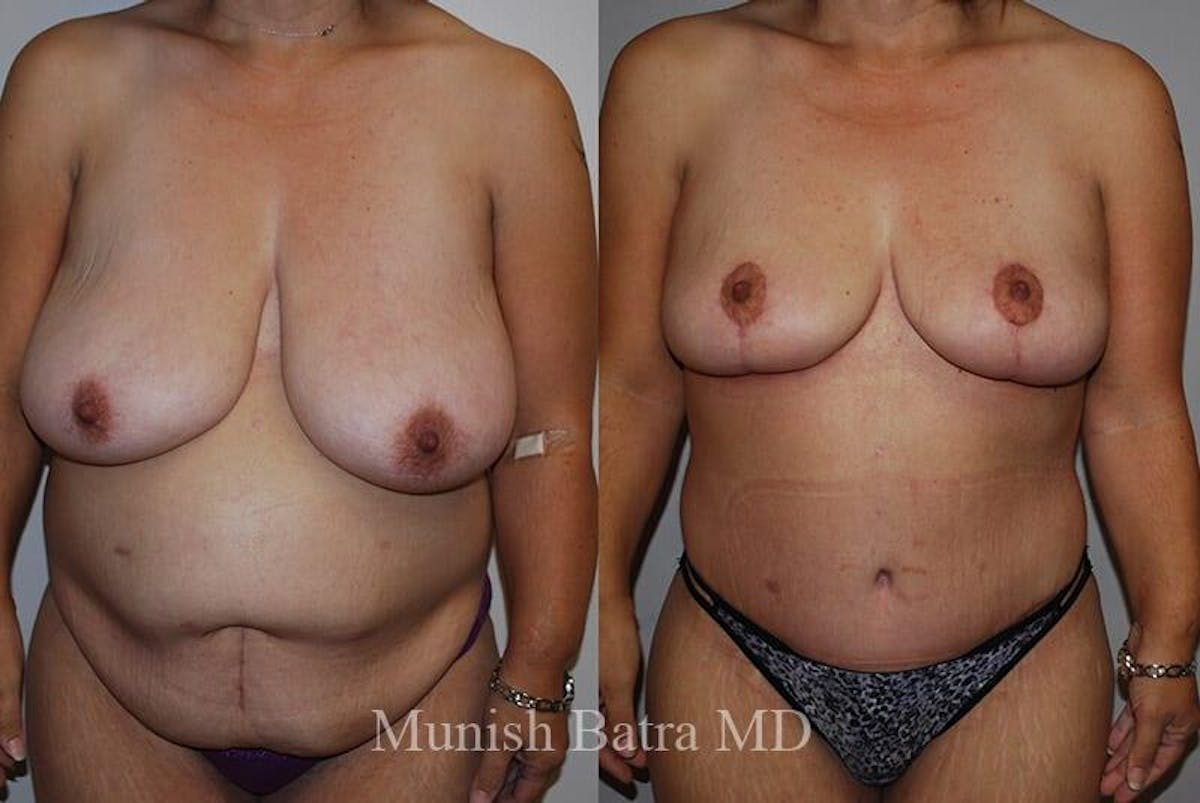 Breast Lift Before & After Gallery - Patient 869746 - Image 1
