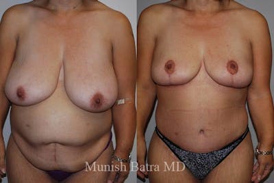 Breast Lift Before & After Gallery - Patient 869746 - Image 1