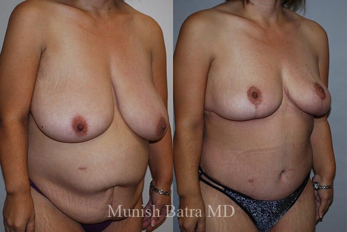 Breast Lift Before & After Gallery - Patient 869746 - Image 2
