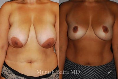 Breast Lift – Reduction Before & After Gallery - Patient 404091 - Image 1