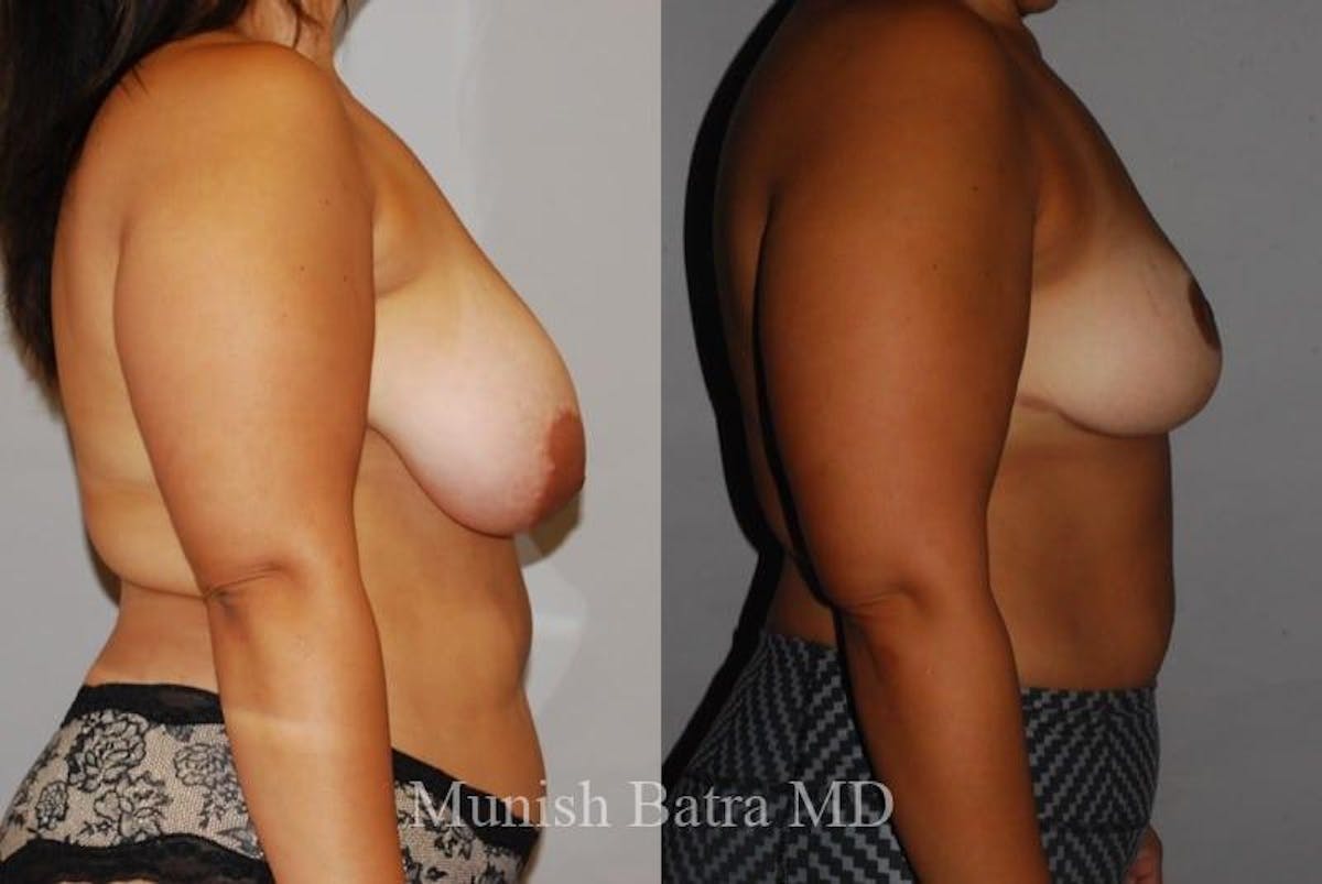 Breast Lift – Reduction Before & After Gallery - Patient 404091 - Image 2