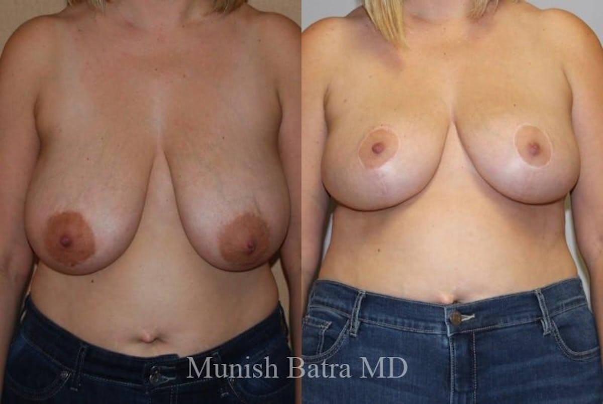Breast Lift – Reduction Before & After Gallery - Patient 275059 - Image 1