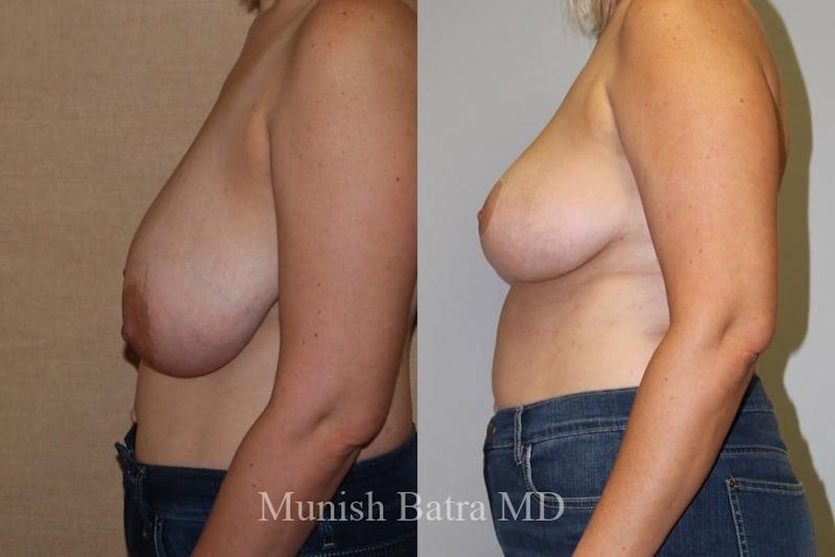 Breast Lift – Reduction Before & After Gallery - Patient 275059 - Image 2