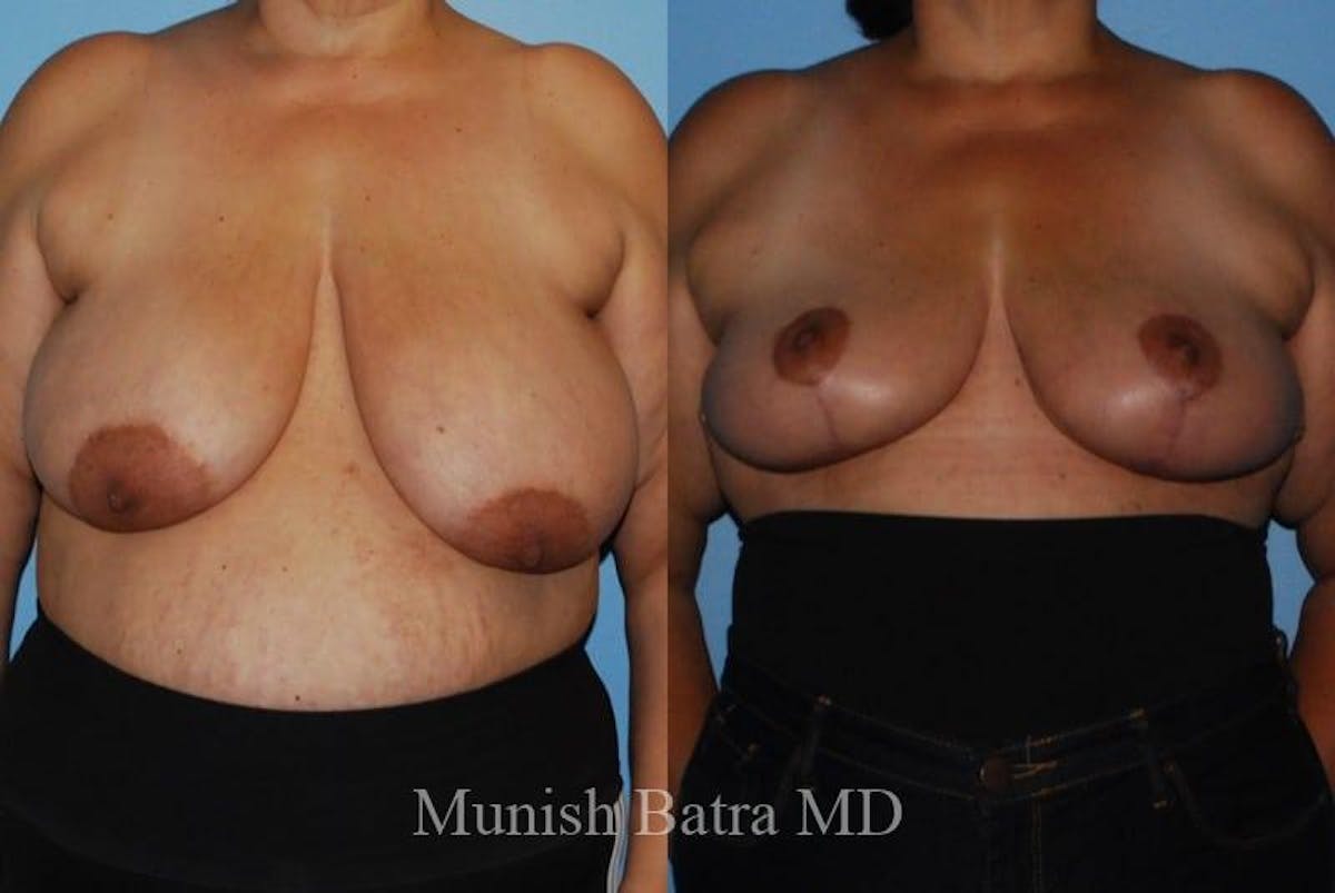 Breast Lift – Reduction Before & After Gallery - Patient 198410 - Image 1