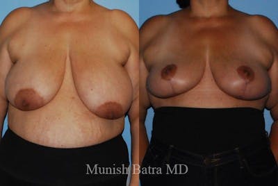 Breast Lift – Reduction Before & After Gallery - Patient 198410 - Image 1