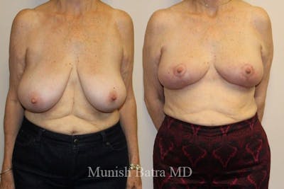 Breast Lift – Reduction Before & After Gallery - Patient 277653 - Image 1