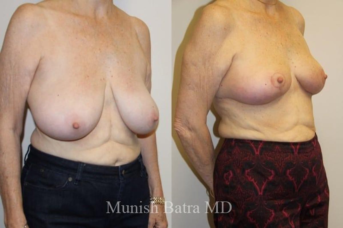 Breast Lift – Reduction Before & After Gallery - Patient 277653 - Image 2