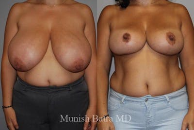 Breast Lift – Reduction Before & After Gallery - Patient 227373 - Image 1
