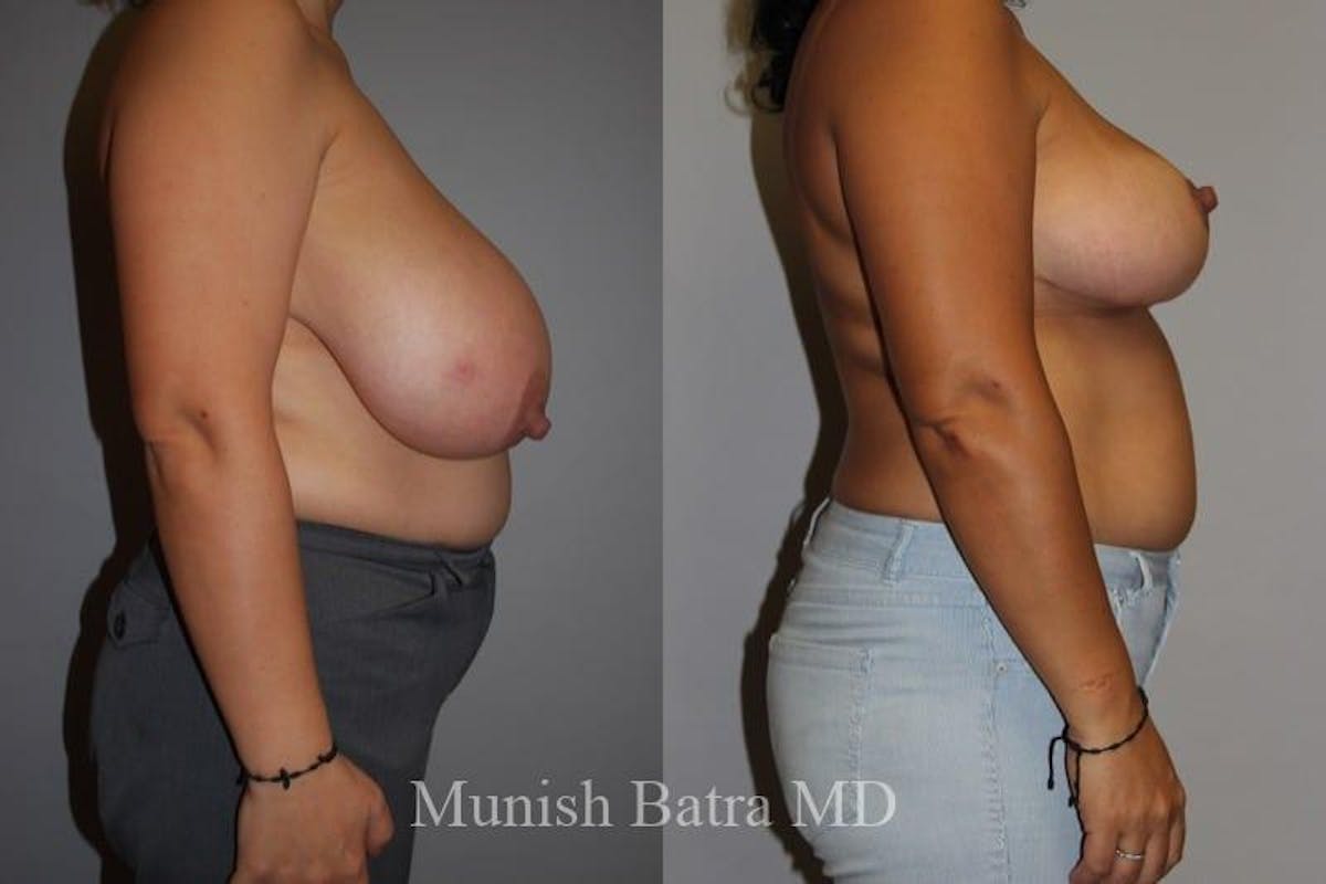 Breast Lift – Reduction Before & After Gallery - Patient 227373 - Image 2