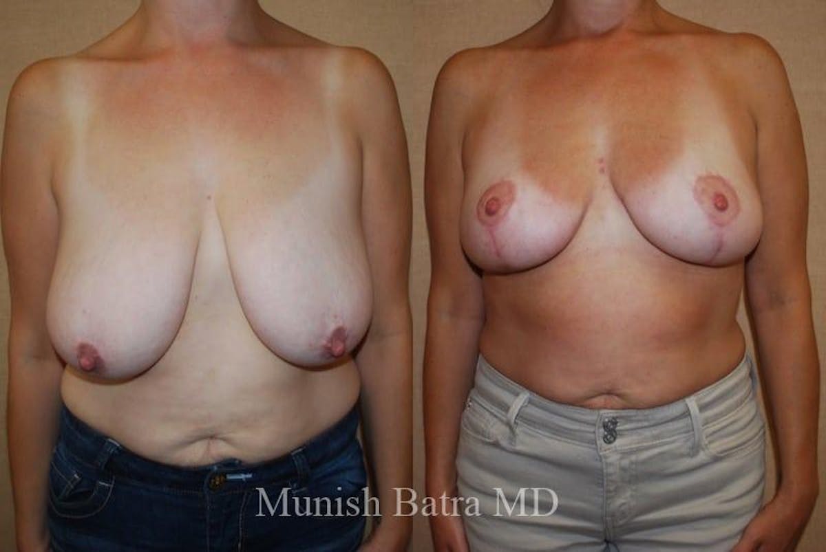 Breast Lift – Reduction Before & After Gallery - Patient 355439 - Image 1