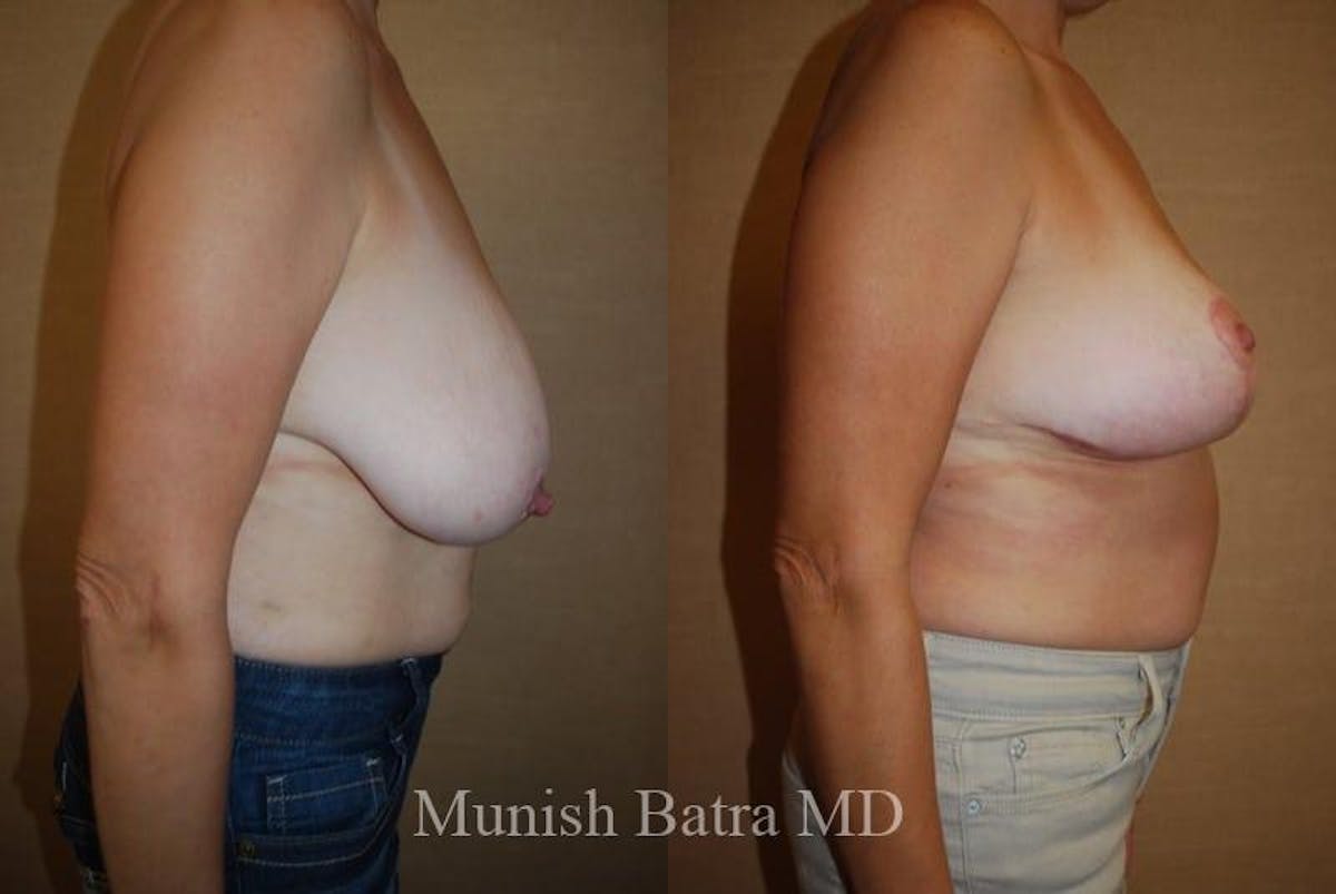 Breast Lift – Reduction Before & After Gallery - Patient 355439 - Image 2