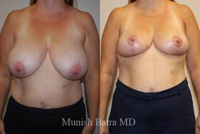 Breast Lift – Reduction Before & After Gallery - Patient 383194 - Image 1