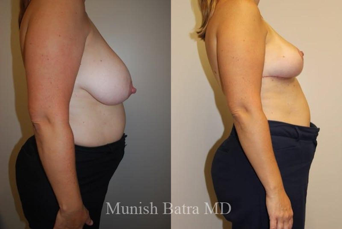 Breast Lift – Reduction Before & After Gallery - Patient 383194 - Image 2
