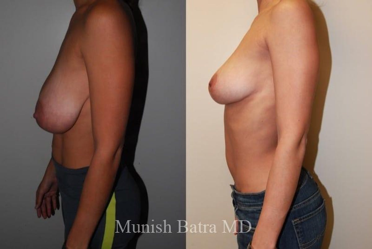 Breast Lift – Reduction Before & After Gallery - Patient 292234 - Image 2