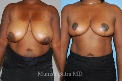 Breast Lift – Reduction Before & After Gallery - Patient 355018 - Image 1