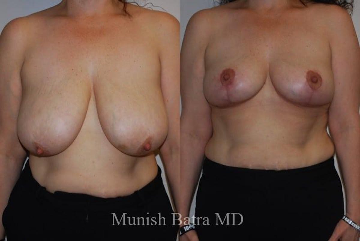 Breast Lift – Reduction Before & After Gallery - Patient 214169 - Image 1