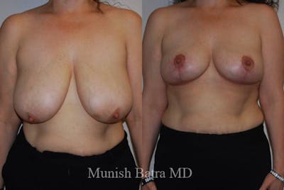 Breast Lift – Reduction Before & After Gallery - Patient 214169 - Image 1