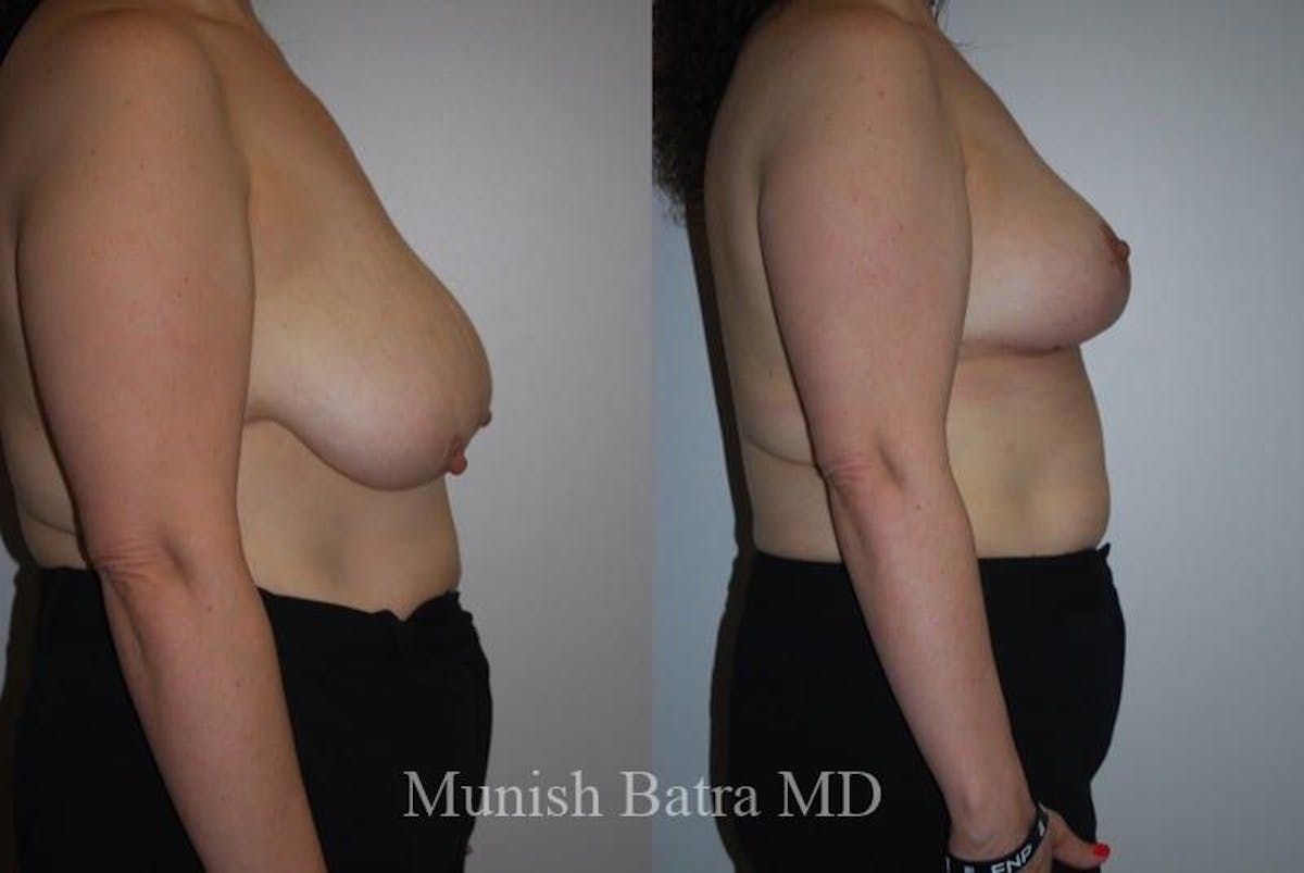 Breast Lift – Reduction Before & After Gallery - Patient 214169 - Image 2