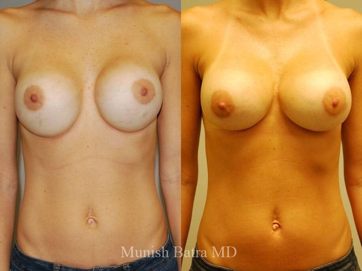 Complex Breast Before & After Gallery - Patient 874212 - Image 1