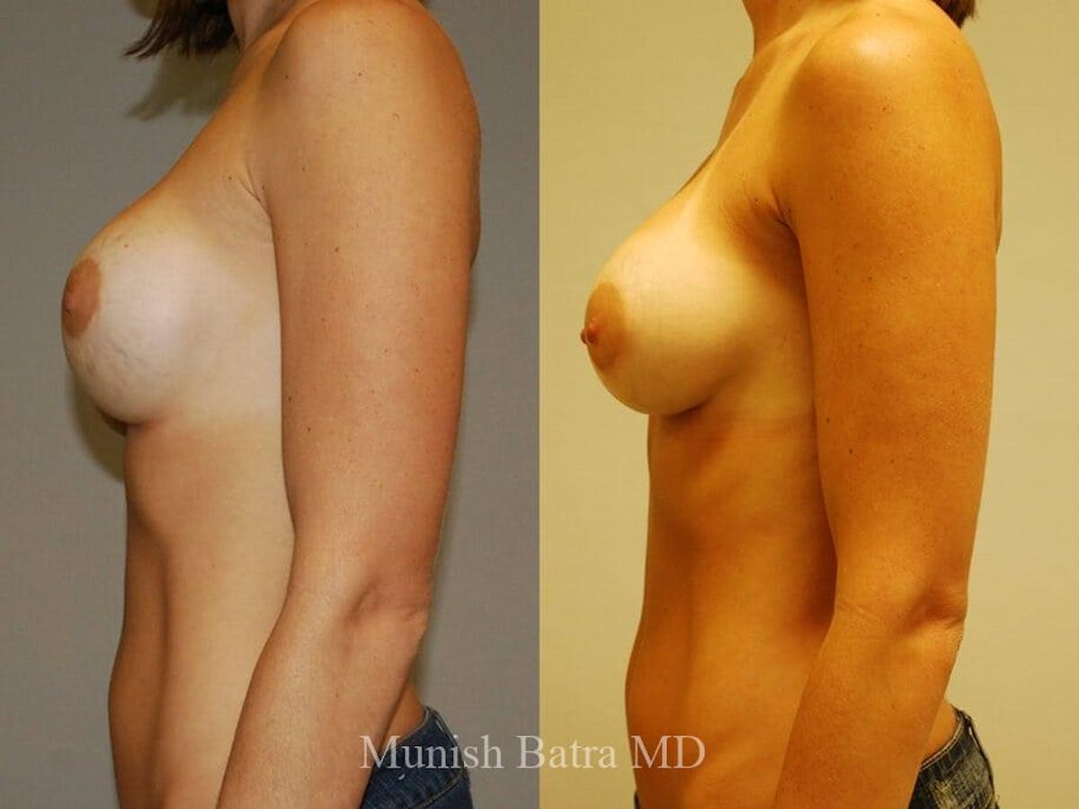 Complex Breast Before & After Gallery - Patient 874212 - Image 2