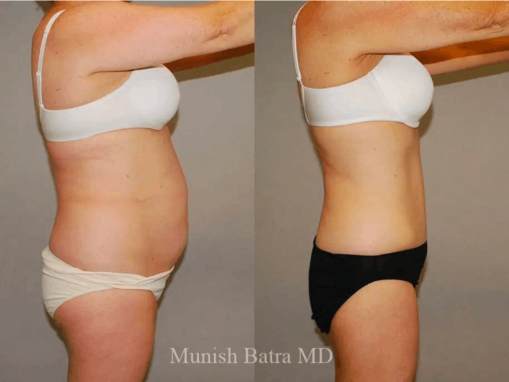tummytuckphoto Before and after photos of a tummy tuck patient in San Diego, CA