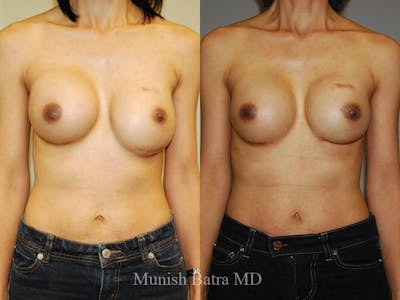 Complex Breast Before & After Gallery - Patient 926299 - Image 1