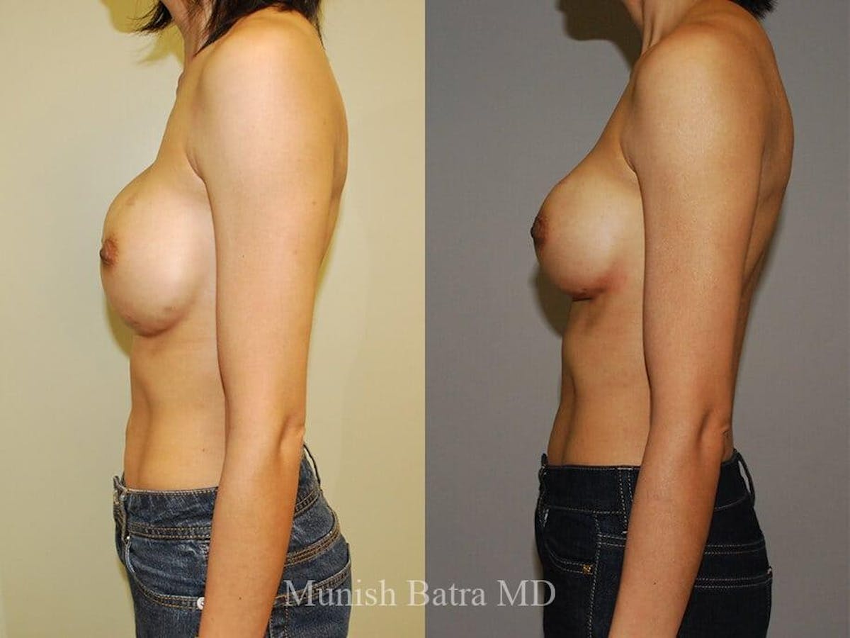 Complex Breast Before & After Gallery - Patient 926299 - Image 2