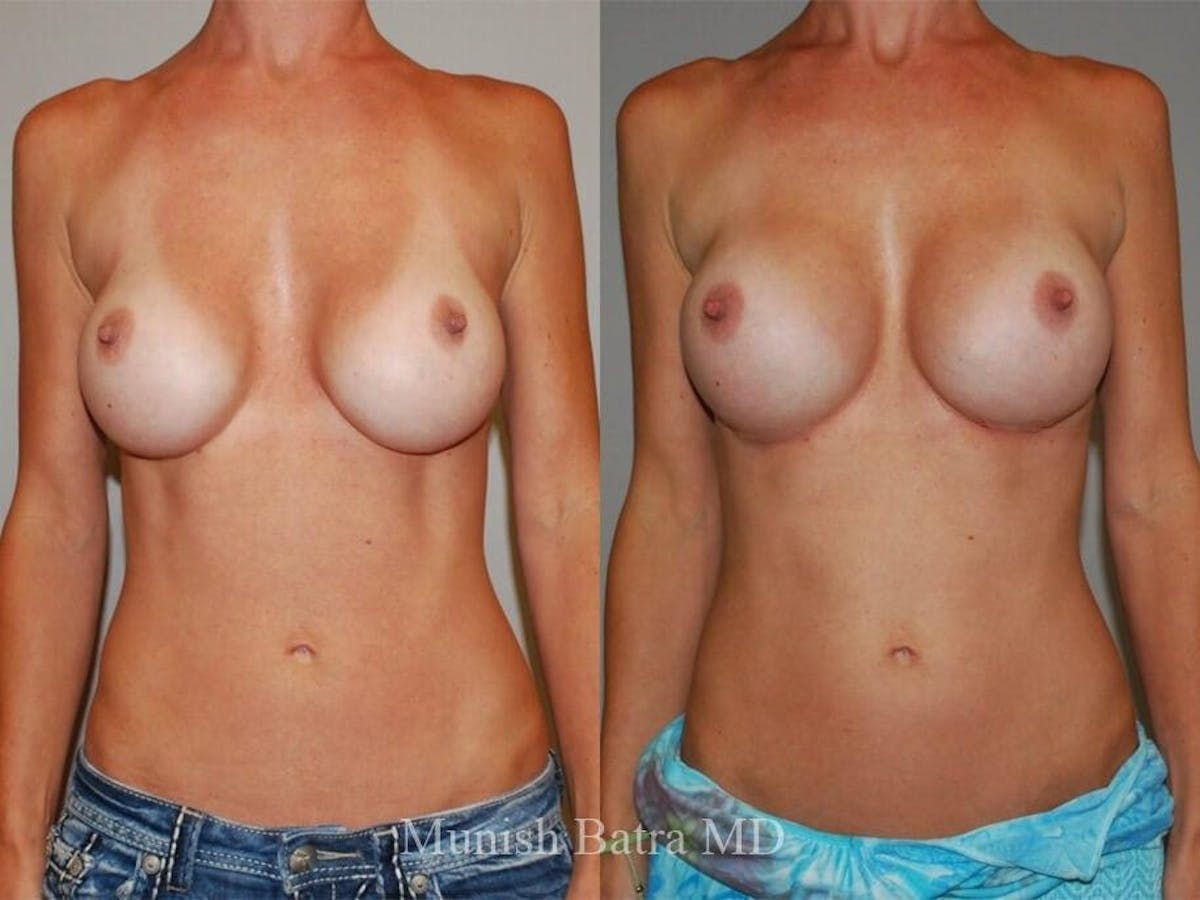 Complex Breast Before & After Gallery - Patient 321988 - Image 1
