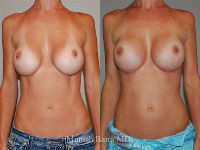 Complex Breast Before & After Gallery - Patient 321988 - Image 1