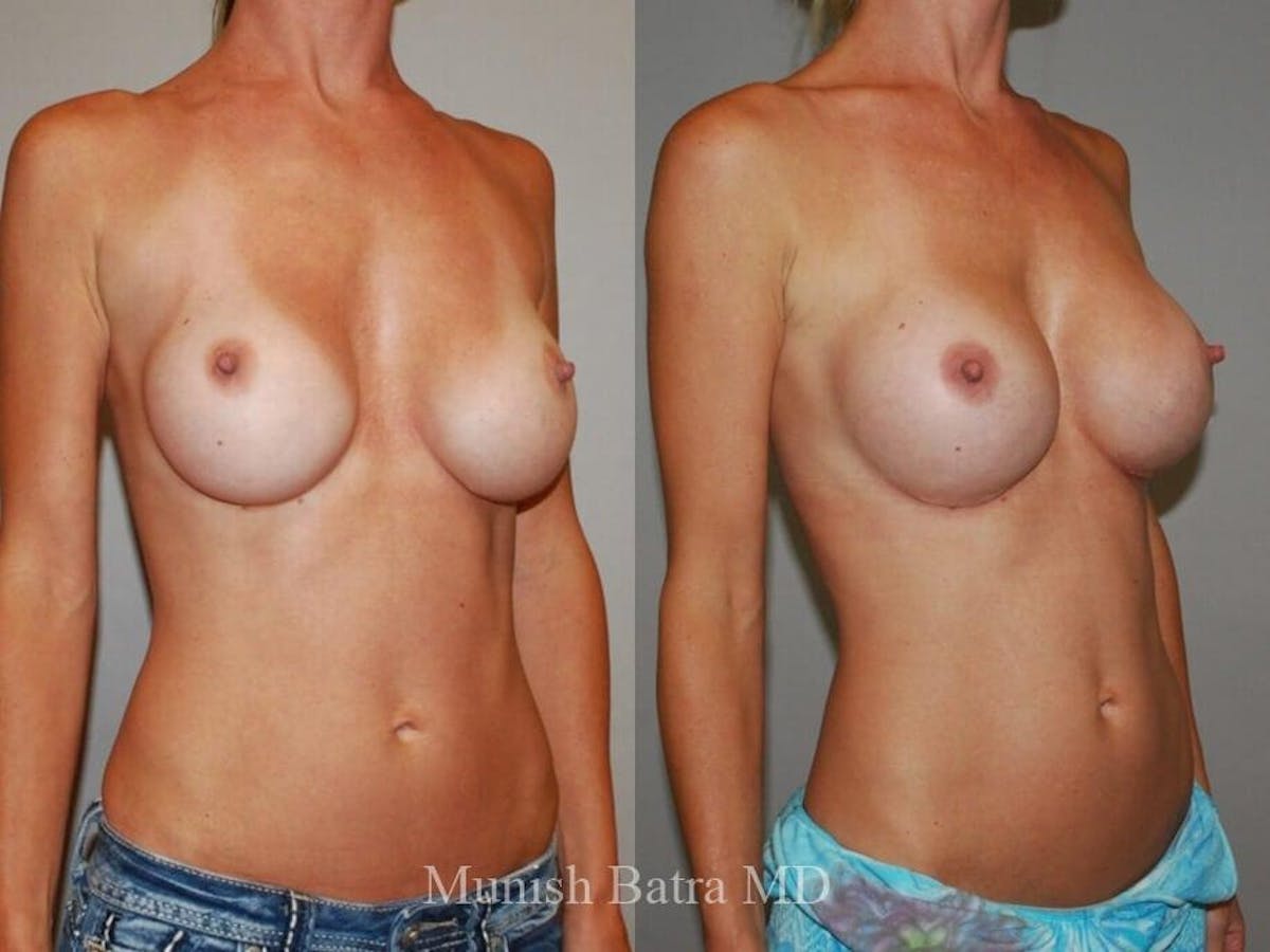 Complex Breast Before & After Gallery - Patient 321988 - Image 2