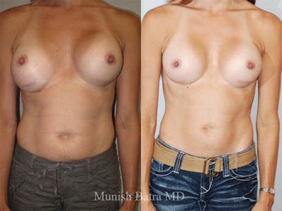 Complex Breast Before & After Gallery - Patient 206885 - Image 1