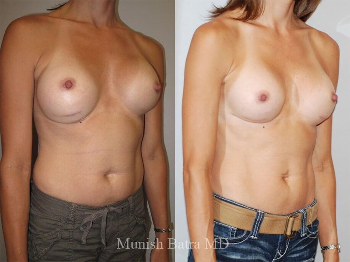 Complex Breast Before & After Gallery - Patient 206885 - Image 2