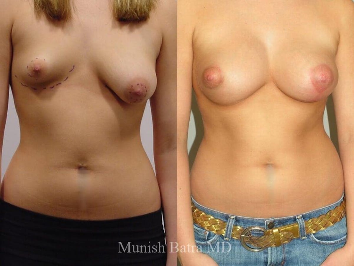 Complex Breast Before & After Gallery - Patient 231857 - Image 1