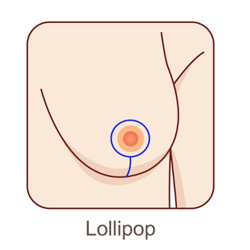 lollipop-breast-reduction Illustration of the lollipop incision technique.