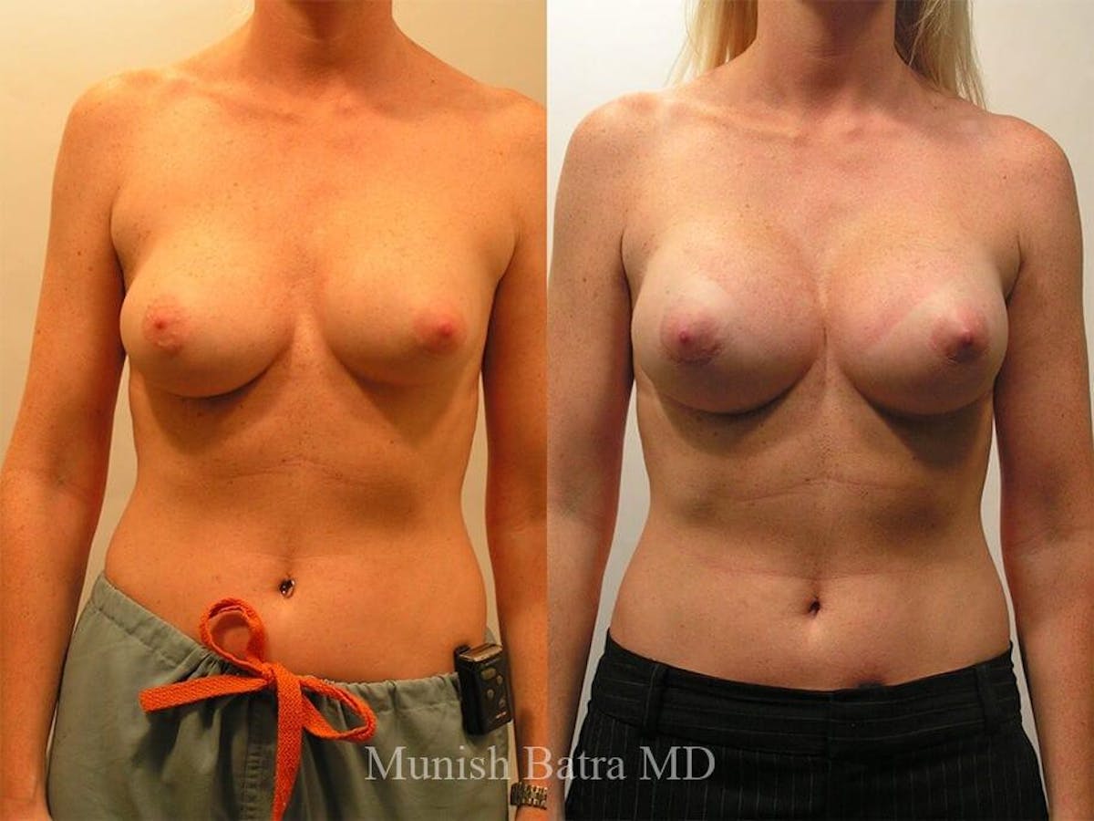 Complex Breast Before & After Gallery - Patient 361327 - Image 1