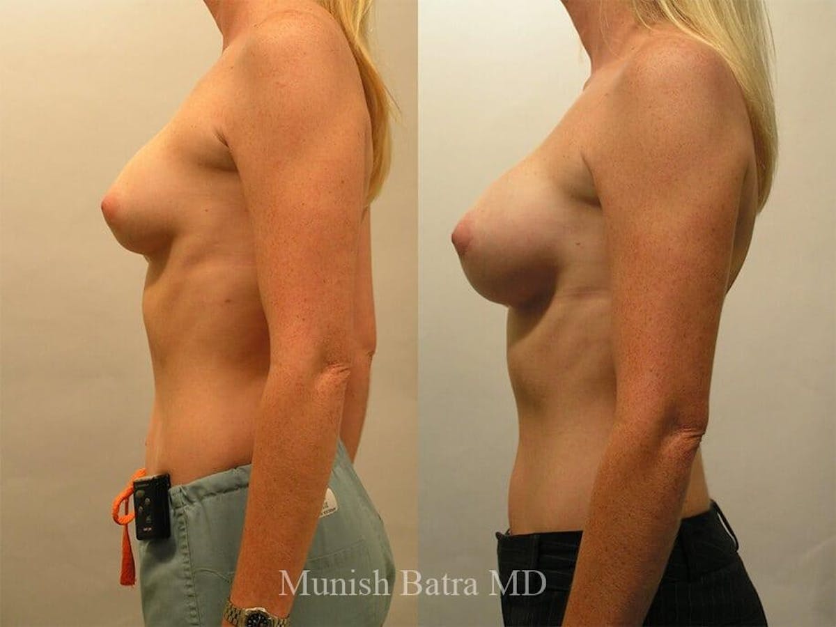 Complex Breast Before & After Gallery - Patient 361327 - Image 2