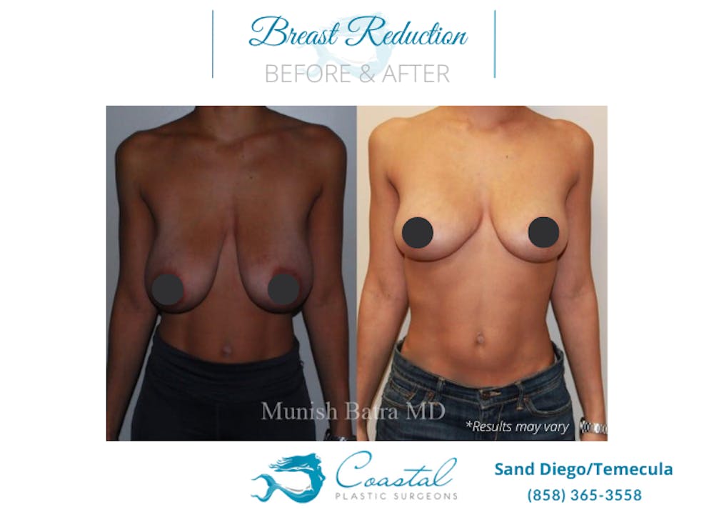 breast-reduction-before-after-coastal-Patient-8-Front Before and after image showing the results of a breast reduction performed in San Diego, CA.