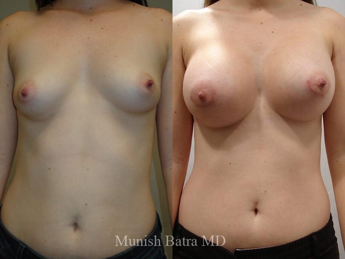 Complex Breast Before & After Gallery - Patient 239084 - Image 1
