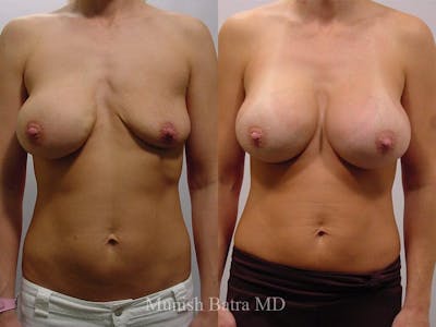 Complex Breast Before & After Gallery - Patient 201675 - Image 1