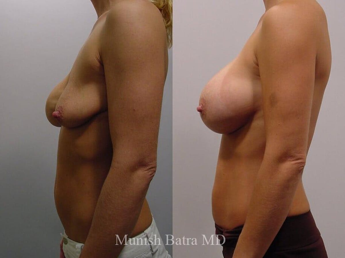 Complex Breast Before & After Gallery - Patient 201675 - Image 2